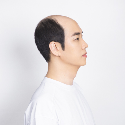 탈모 유형