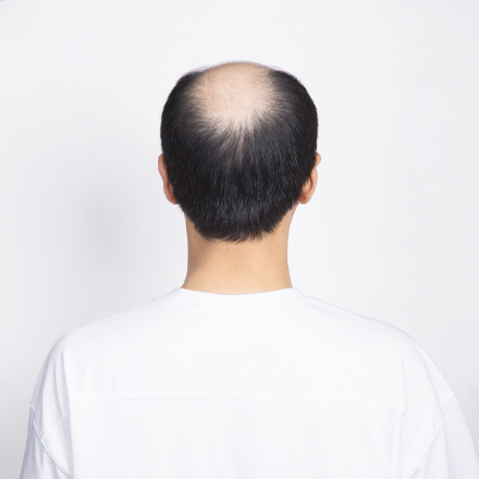 탈모 유형